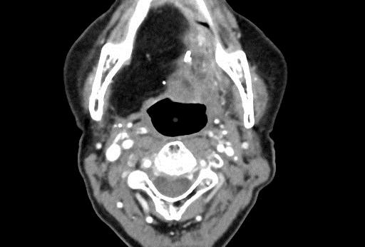 Imaging Recommendations NCCN leaves the door open Surveillance after therapy Contrasted CT or MRI at 6-8 weeks, PET-CT at 12 weeks Annual chest imaging Future imaging based on initial findings,