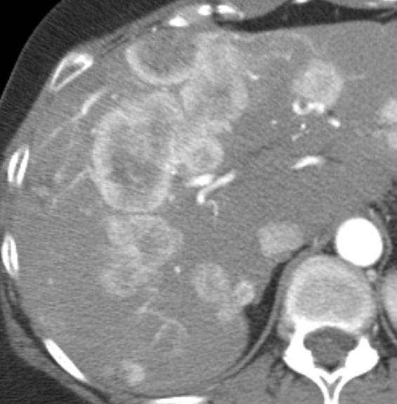 Liver Metastases: Multiphasic Imaging While classically hyper/hypo (art/pv), lesions can be very varied