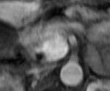 Fat suppressed T2 Diffusion weighted imaging