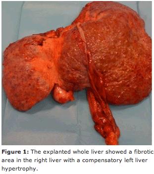 SIRT to modulate liver volumes Radiation lobectomy Combining tumoricidal effect As an alternative to portal vein embolization : Tumor growth