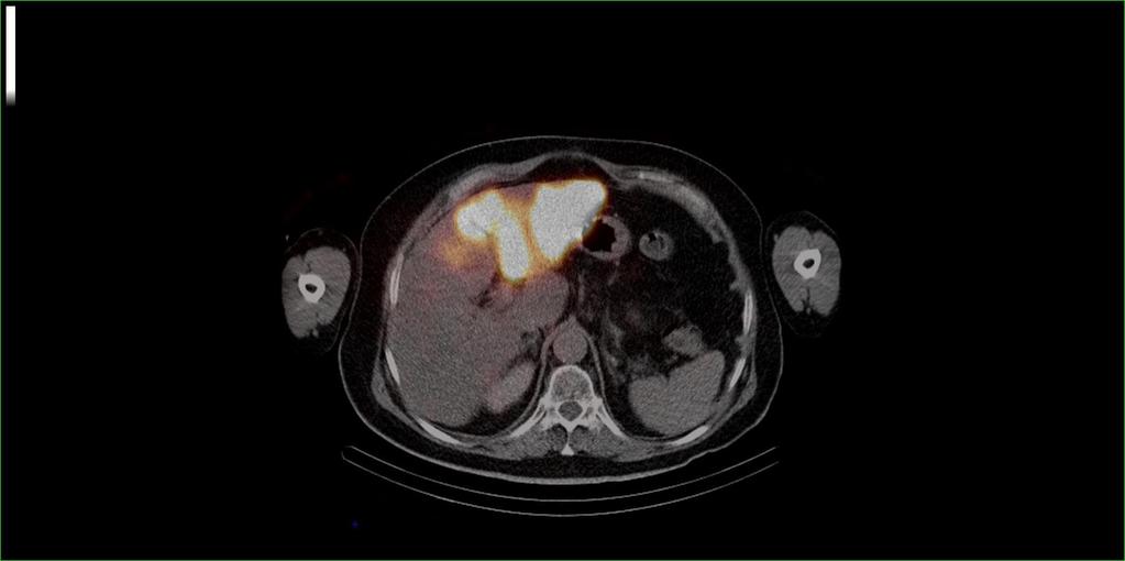 Clinical case: Post-SIRT 90Y PET tumor distribution of Y90 (161