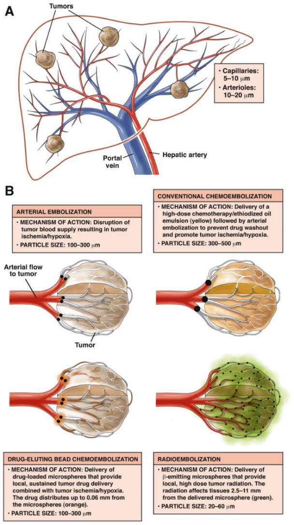 Locoregional Transarterial Therapies for HCC Transarterial Chemoembolization (TACE) Intra-arterial infusion of chemotherapy and proximal embolization Ischemic-cell death Selective