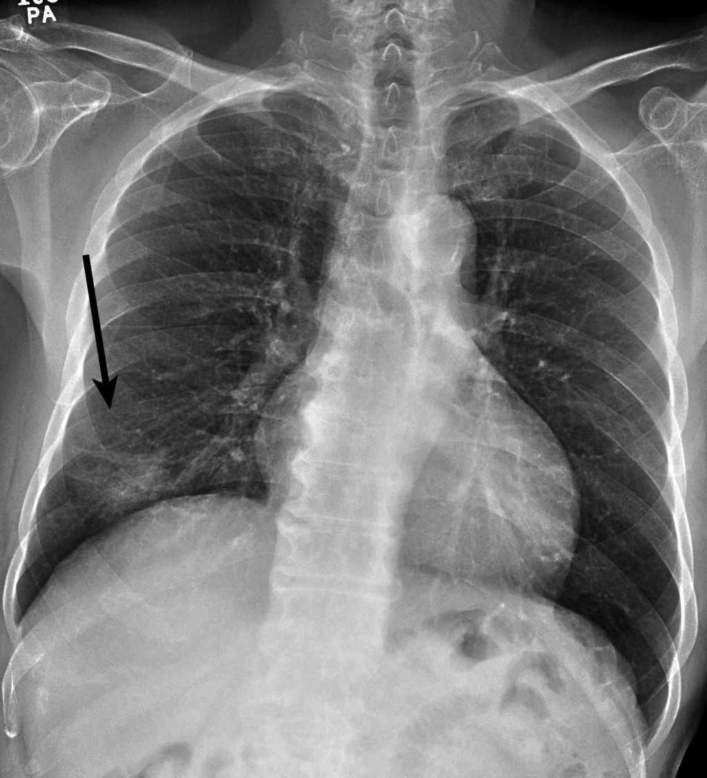 Synchronous Primary Lung Cancers A B C D Fig. 1. 72-year-old man with synchronous triple primary lung cancers. A, B. Posteroanterior (A) and lateral (B) chest radiographs reveal 4.