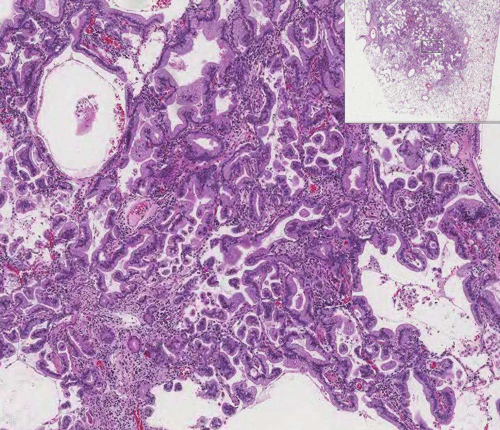 It revealed adenocarcinoma with moderate differentiation and acinar pattern showing acini of polyhedral cells.