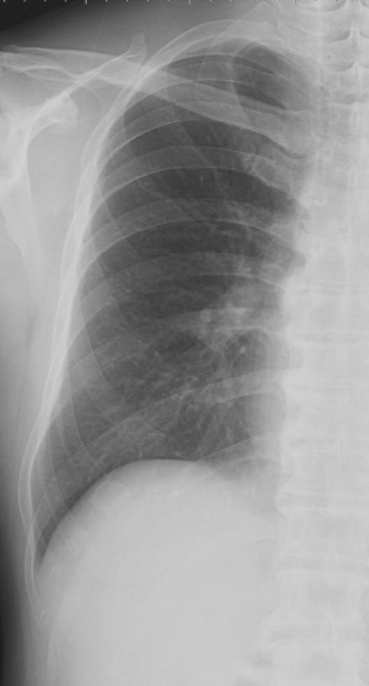 Serial Chest Radiographs