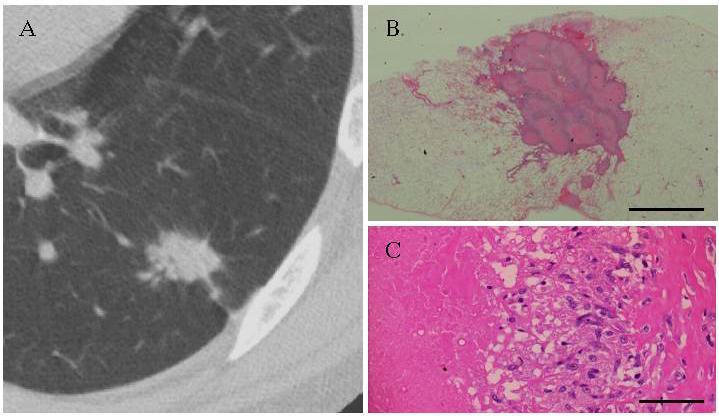 Pulmonary cryptococcosis mimicking lung