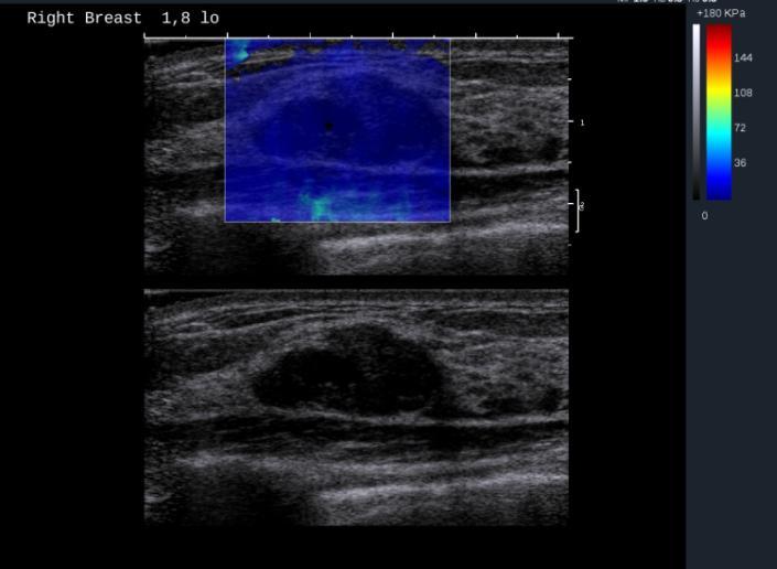 2010 Chang JM, et al. Clinical application of shear wave elastography (SWE) in the diagnosis of benign and malignant breast diseases. Breast Cancer Res Treat. 2011 Berg WA, et al.