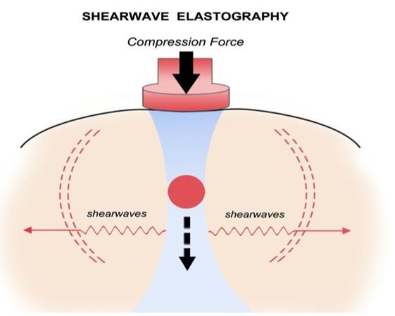 Two types of Elasticity Imaging Strain elastography Shear wave elastography Compression