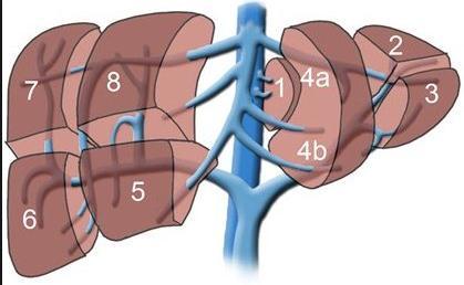 PRETEXT staging Based on liver segments Hepatoblastoma Left lateral section (2, 3) Left medial section (4a, 4b) Right anterior section (5,8) Right