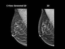 Reducing Radiation with Tomo 2D + 3D is double radiation dose Dose reduced to similar level using synthesized 2D