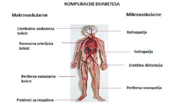 Slika 1. Prikaz komplikacija šećerne bolesti (http://diabetessymptomstype2.com/complicationsof-diabetes/) 1.3.