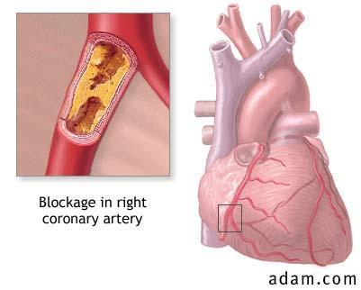 Medical Diagnosis: Heart Attack as an Example Heart attack: