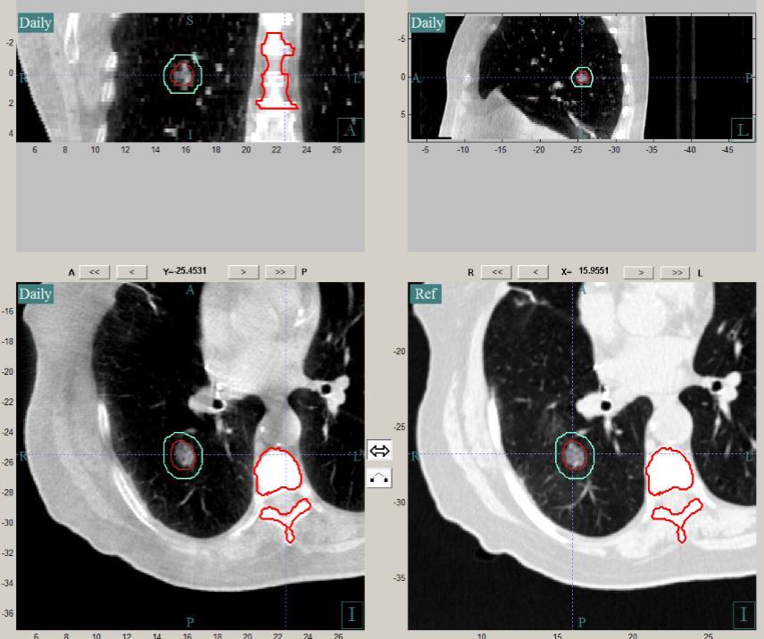 Breath-hold CBCT to improve image quality Some of the poor quality in current generation CBCT in the lung is due to