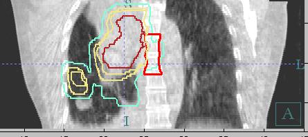 CBCT used to trigger a new planning CT Planning CT CBCT Obvious Geometric Miss Shifting