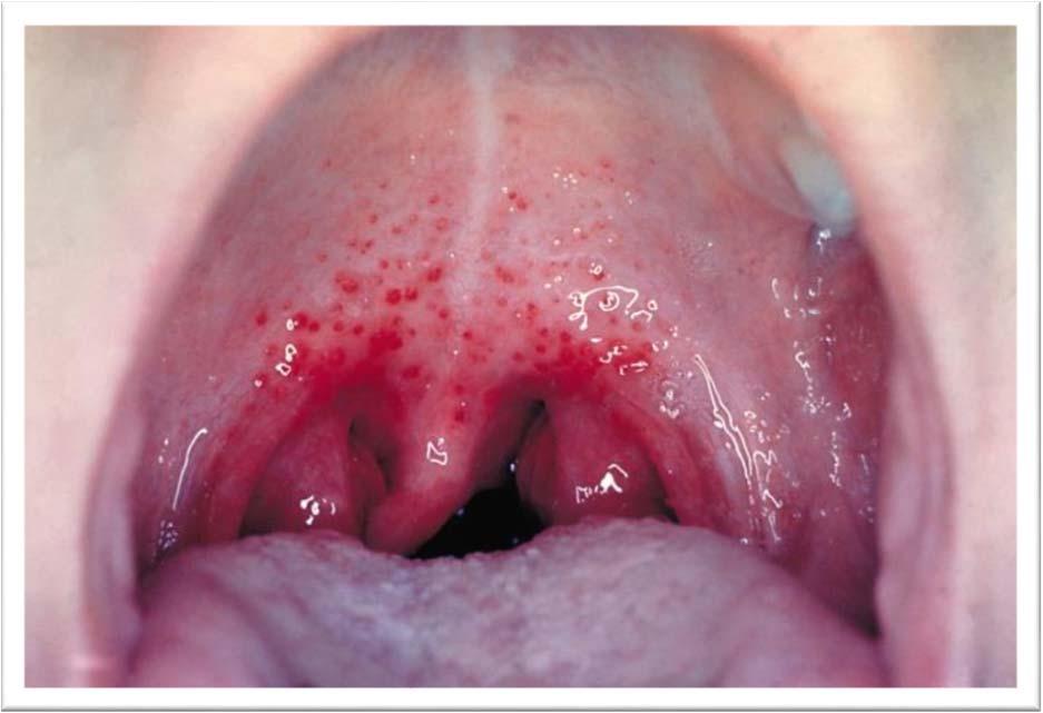 Rheumatic Fever Occurs following pharyngitis caused by certain strains of group A streptococcus after a latency