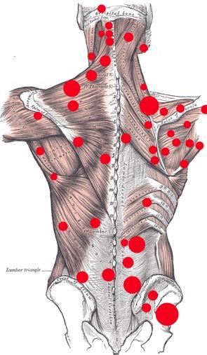 What is a trigger point or knot? Trigger points or trigger sites are described as hyperirritable spots in skeletal muscle that are associated with palpable nodules in taut bands of muscle fibers.
