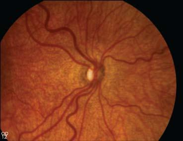 But this congenital condition, defined by small optic discs in one or both eyes, seems to have become more prevalent in the past decades.
