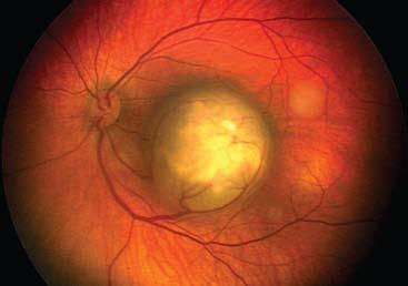 genes that drive the proliferation of all retinal cells malignant and therapeutic. By studying this area you actually get a bigger bang for your buck, he says.