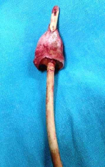 152 examination revealed a retained urinary catheter with its external end cut.