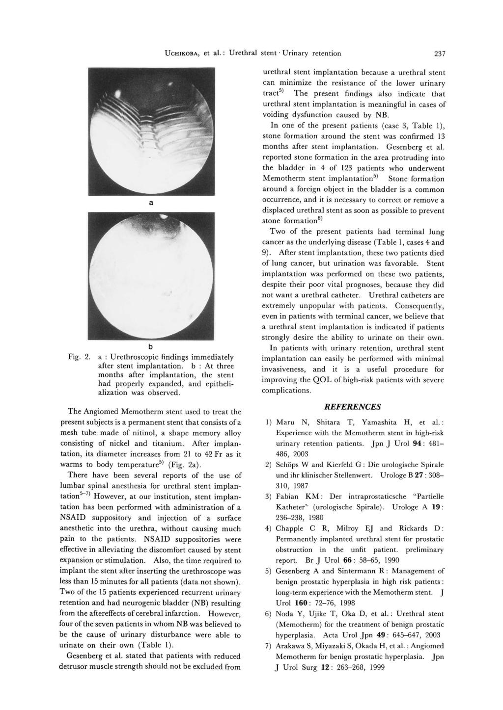 UCHIKOBA, et al.: Urethral stent Urinary retention 237 Fig. 2. a b a: Urethroscopic findings immediately after stent implantation.