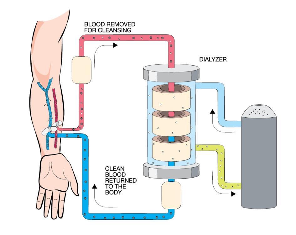 DIALYSIS External filtration of toxins, fluid management, and