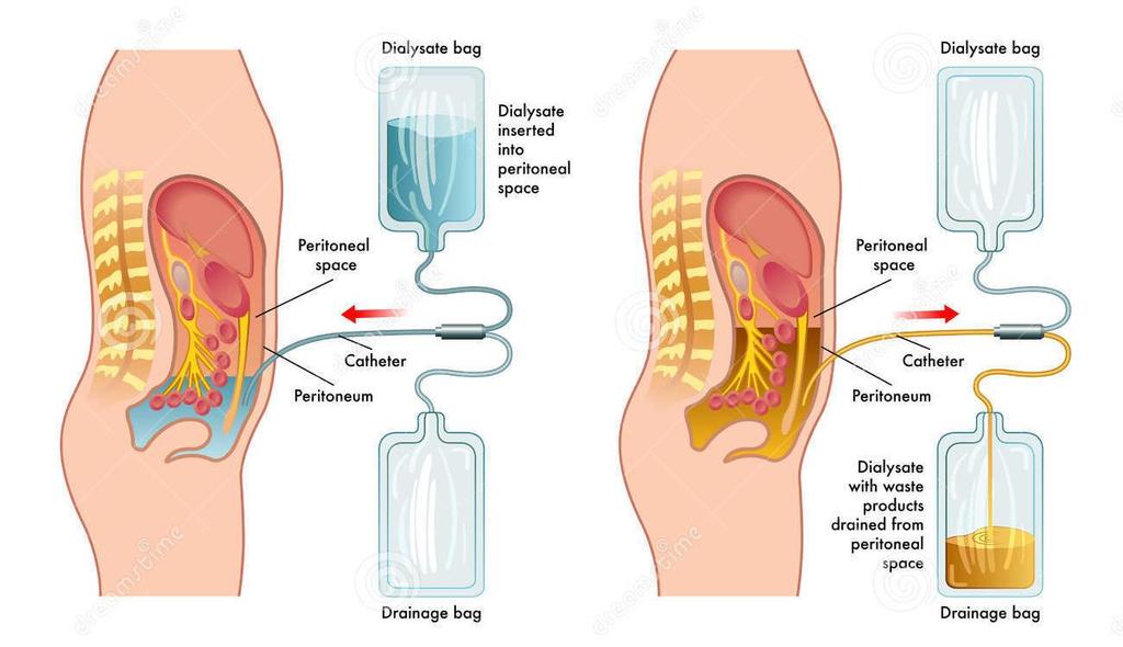 PERITONEAL DIALYSIS Process Large amount of dialysis fluid infused into abdomen