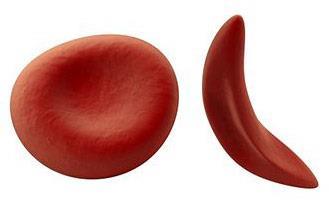 SICKLE CELL Red blood cell changes Sickle shaped Rigid
