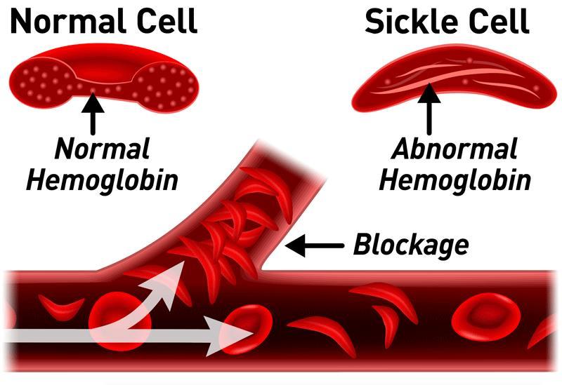 SICKLE CELL CRISIS Inadequate blood flow to vital organs