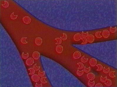 The sickled red blood cells cannot fit through capillaries Causes joint pain, anemia why?