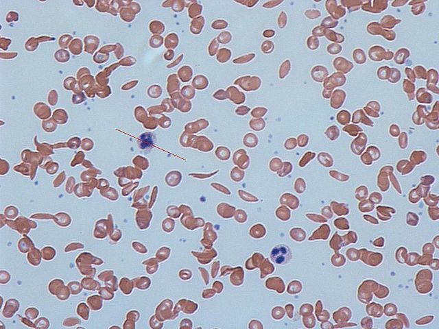 Picture from Wikimedia Commons Sickle Cell Anemia Treatment Preventative care is advisable for managing the symptoms of sickle cell anemia.