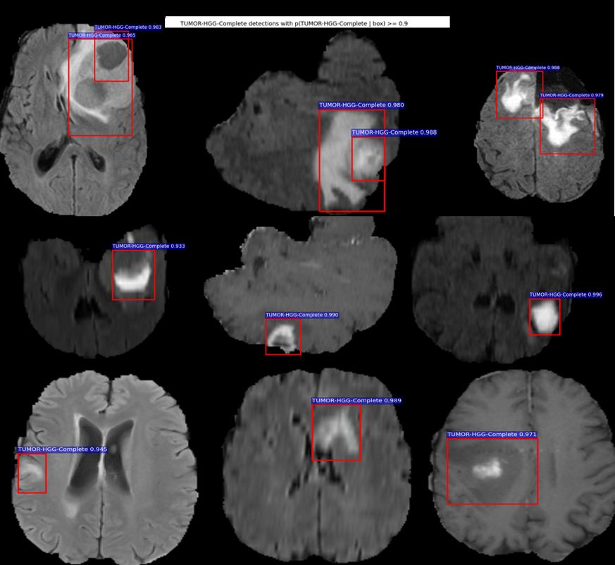 6 Deep Learning for Medical Image Analysis Fig. 6. Tumor high grade glioma detected by our CNN architecture 2.