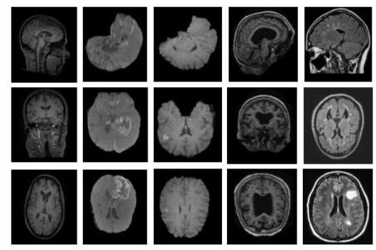 Deep Learning for Medical Image Analysis 9 Fig. 8. We trained our architecture by five different categories of brain MRI. first column shows healthy brain in sagittal, coronal and axial section.