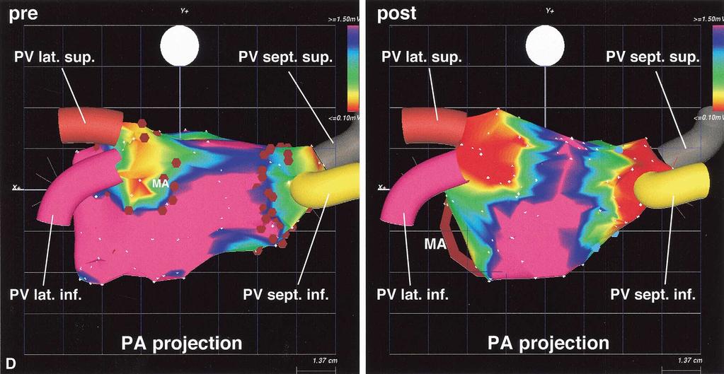 Figure 2 Continued. (D) Comparison of voltage in the pre- and post-ablation maps in a posterior-anterior projection of the LA.