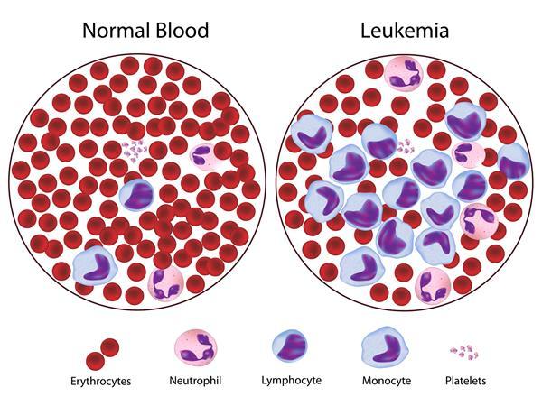 Uses for Stem Cells For example, leukemia is a cancer that affects white blood cells.