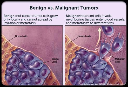Tumour Formation A benign tumour does not harm other surrounding tissues.