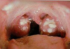 Acute Post-Streptococcal GN History Acute onset of macroscopic haematuria Recent throat or skin infection (impetigo)