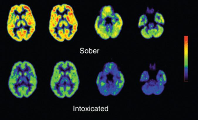Alcohol s Effects on Brain and Behavior Figure 2 Alcohol s effect on the brain BRAIN AREA EFFECTED FUNCTIONS NORMAL: NON-ALCOHOLIC ABNORMAL: ALCOHOLIC As alcohol takes effect, it stimulates and