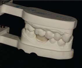 Restoration inserted by dentist The path to the perfect fit A digital scan