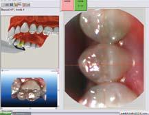 Prior to tooth preparation, the opposing dentition can be scanned by the dental assistant.