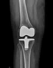 Podobne ako v prípade bedrového kĺbu, len približne s desaťročným oneskorením, vyvstala otázka špeciálnych revíznych implantátov potrebných na riešenie pacientov s uvoľnenými štandardnými implantátmi