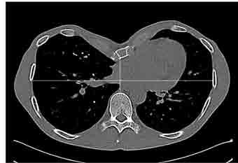 Diagnostika deformity Základné grafické vyšetrenie je predo-zadná röntgenová snímka hrudníka.