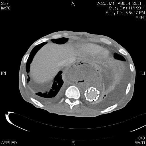 CTA Infected posterior mediastinum
