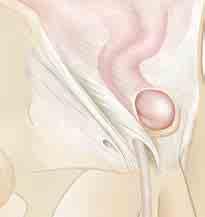 Understanding Inguinal Hernias Inguinal (groin) hernias are common in both men and women. There are tw o types: direct inguinal hernias and indirect inguinal hernias.