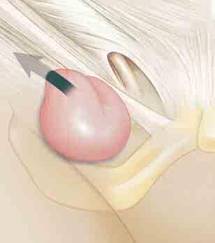 Repairing Femoral Hernias Femoral hernias are more common in women. They result from a weakness in the femoral canal.