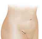Reducing the Hernia An incision is made to reach the weakened area.