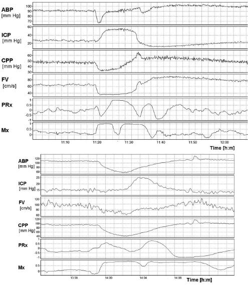 Continuous monitoring of cerebrovascular pressure reactivity Fig. 3. Example of continuous monitoring of PRx in a patient who died after developing suddenly refractory intracranial hypertension.