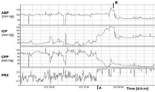The interval between the switch of PRx to radically positive values and a drop in CPP below 50 mm Hg was 45 minutes. Fig. 2.