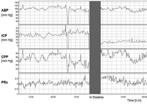 Continuous monitoring of cerebrovascular pressure reactivity Fig. 7. Graph of a patient s PRx after a craniectomy. The mean ICP level was > 30 mm Hg before surgery, with mean PRx ~+0.1.