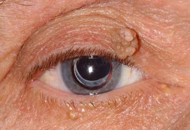 Diseases of the Eyelids: When considering the structure (skin, muscle, blood vessels and tarsus) and function of the eyelids (protection, closure, distribution of tears), we can conclude that