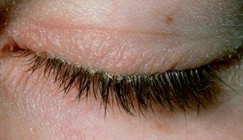 1. Squamous Blepharitis: characterized by lid margin hyperemia, presence of scaly dandruff-like material between cilia, premature loss